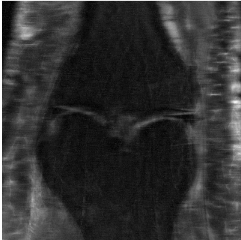 Undersampled MRI